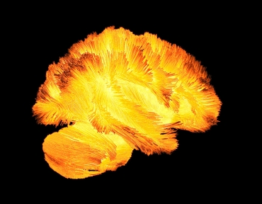 Functional Neurological Disorders